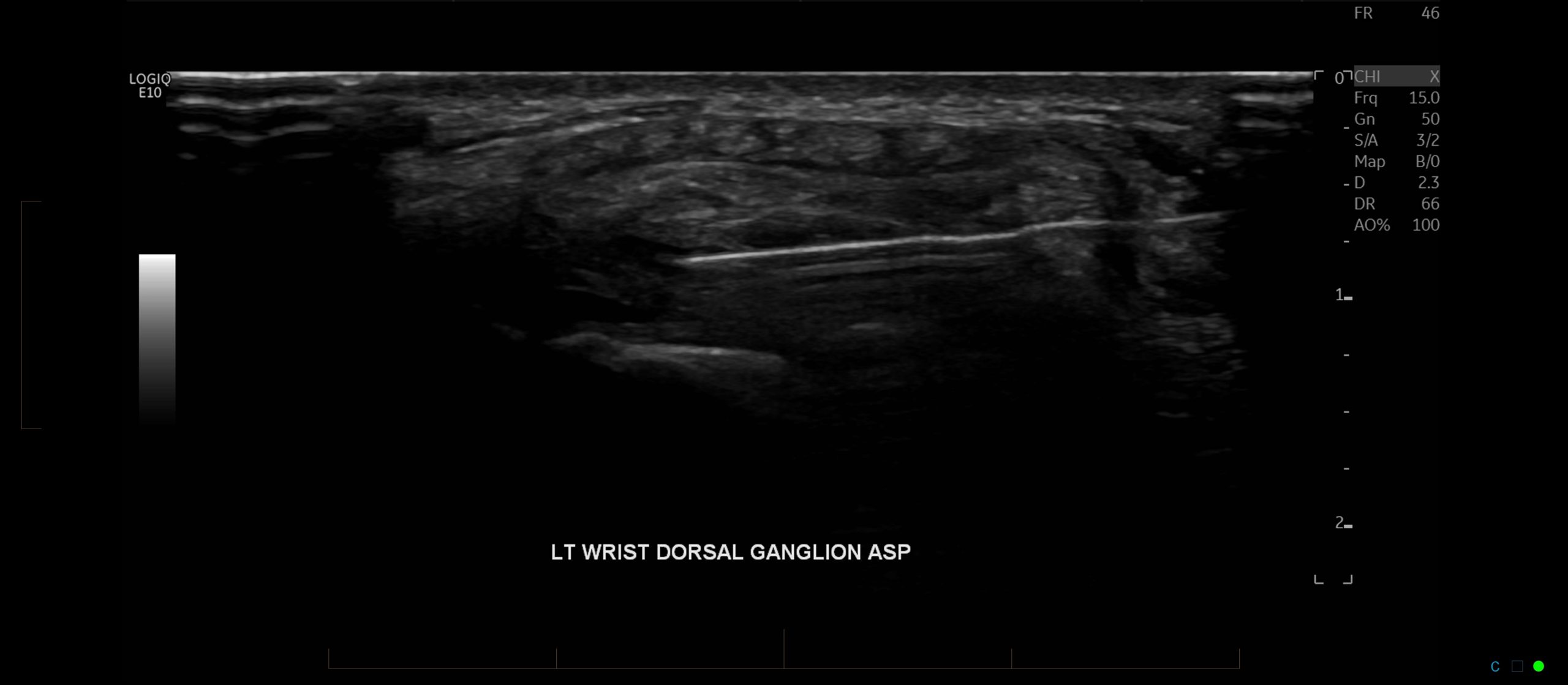 an ultrasound image of wrist pain injection