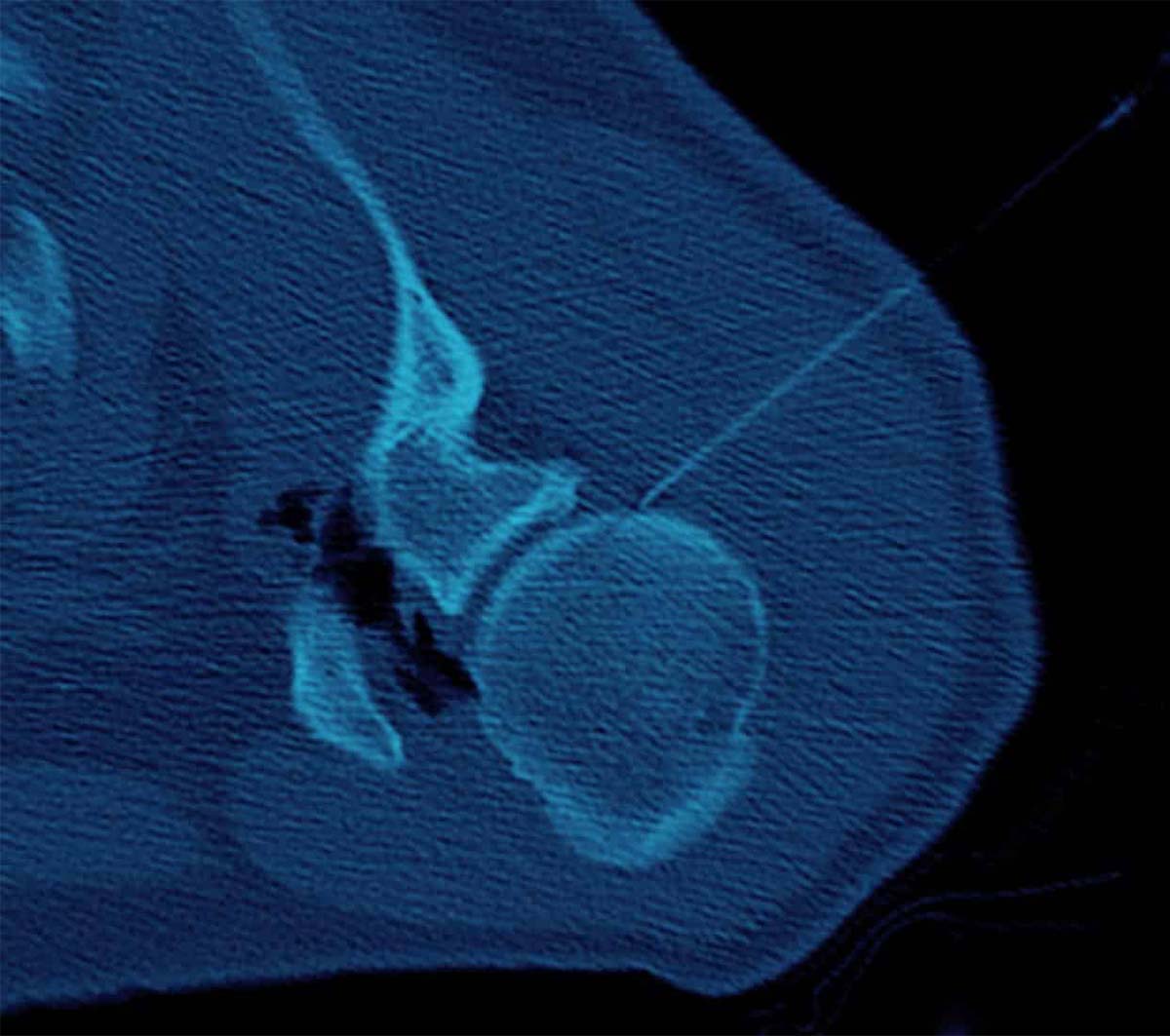 Shoulder Hydrodilatation - Melbourne Radiology